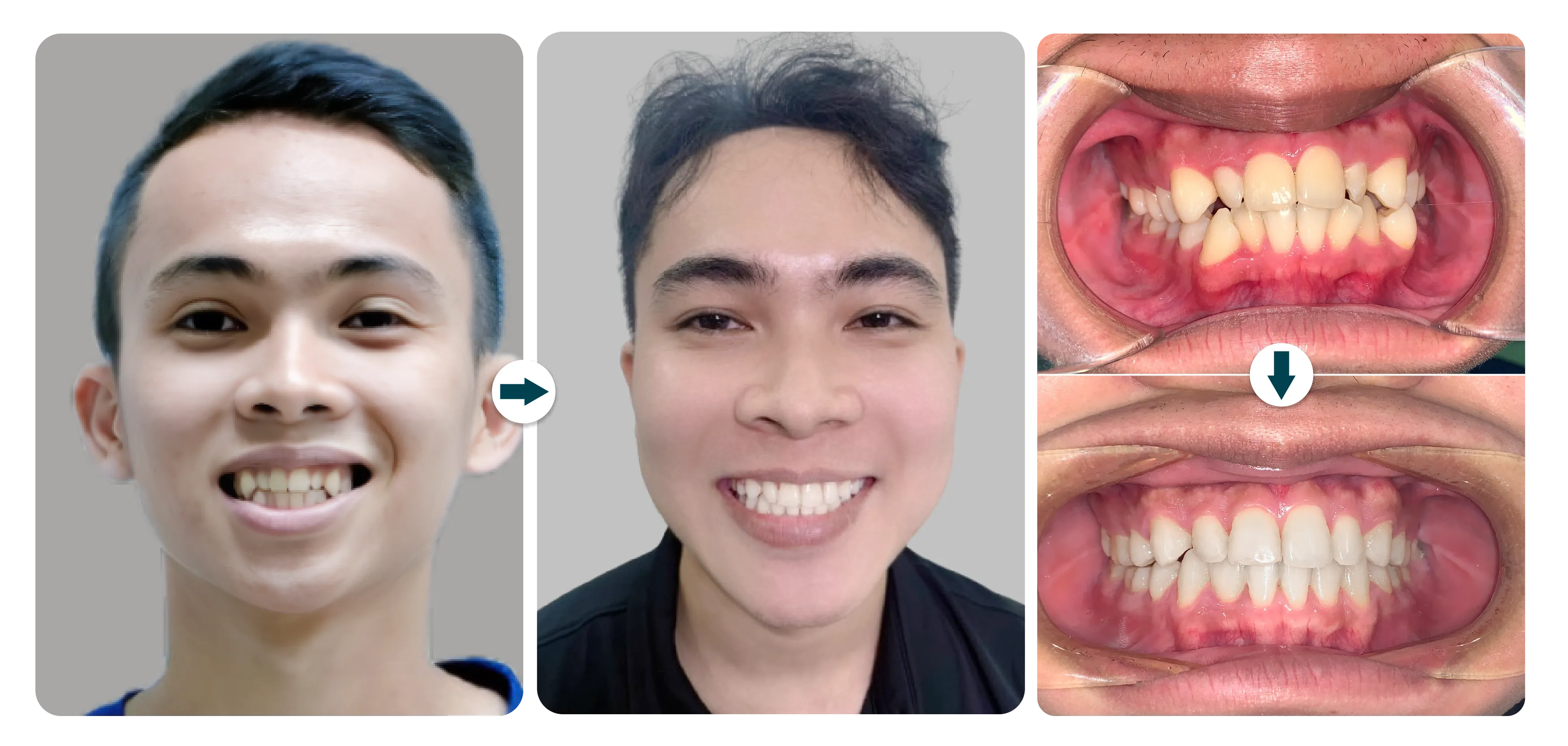 trong-nhan-nieng-rang-smart-kim-loai