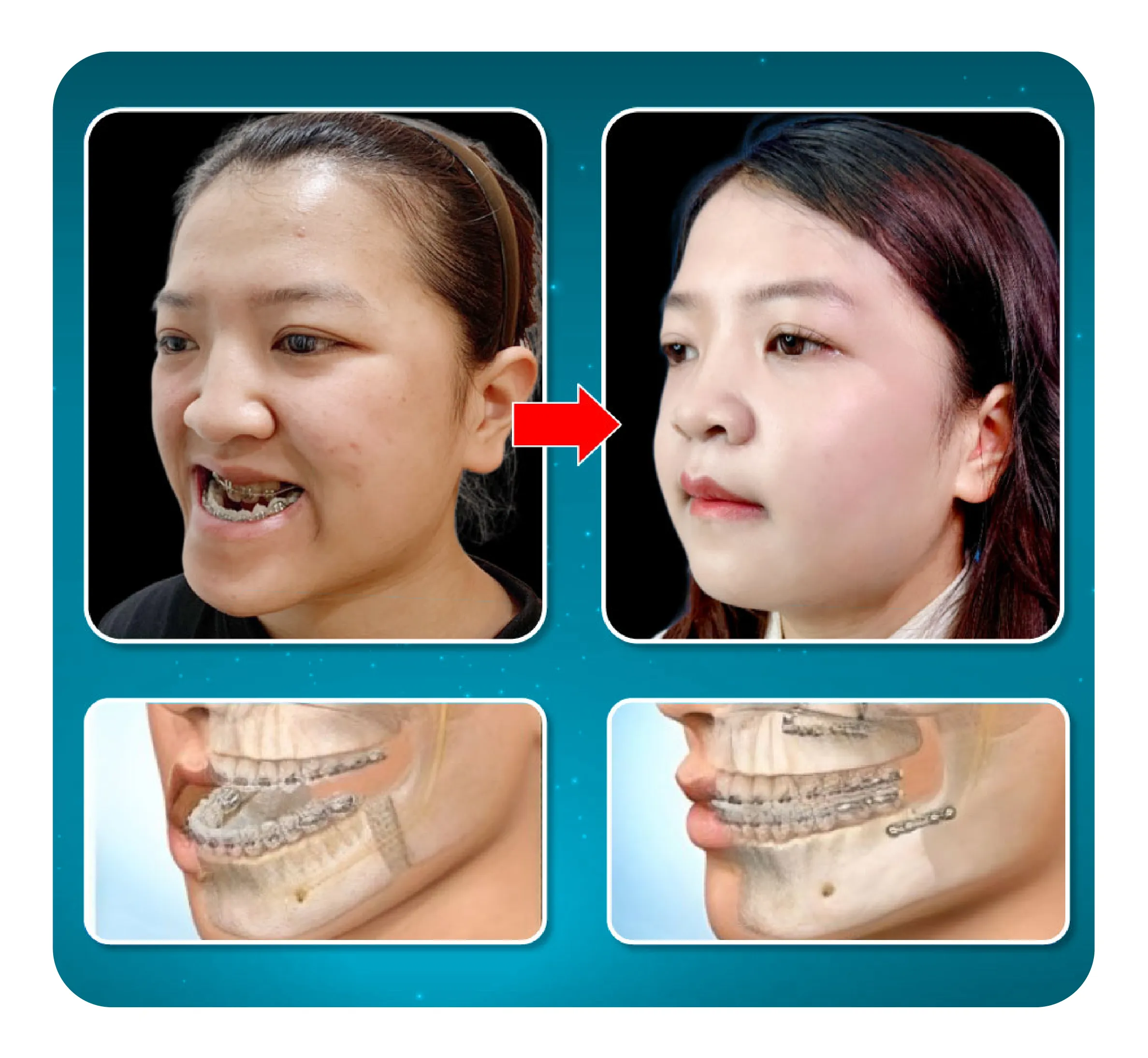 services-phau-thuat-ham-nieng-rang