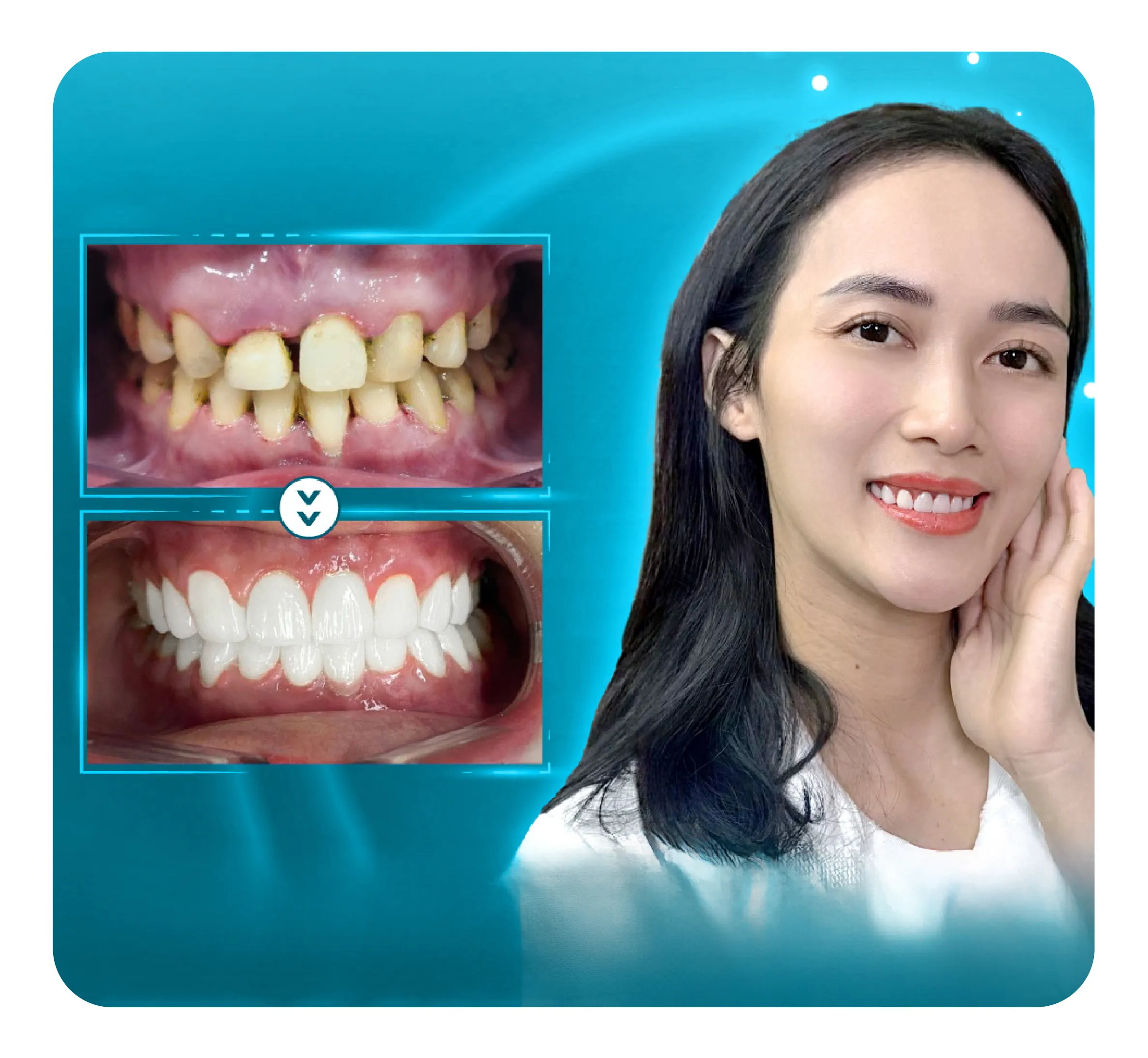 services-rang-su-zirconia