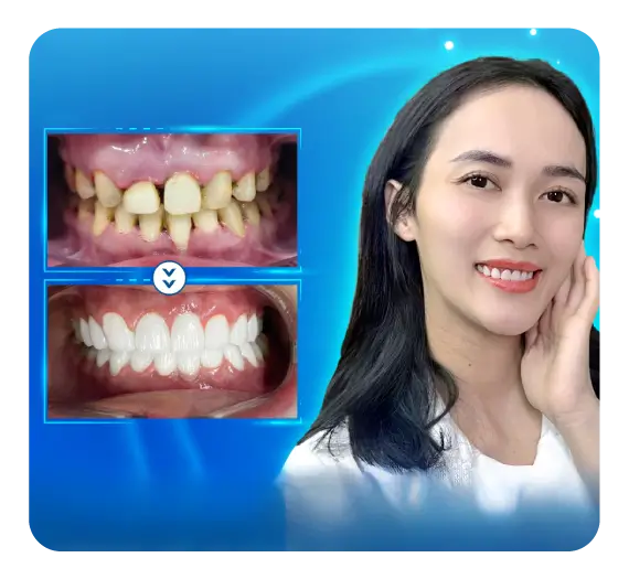 services-rang-su-zirconia