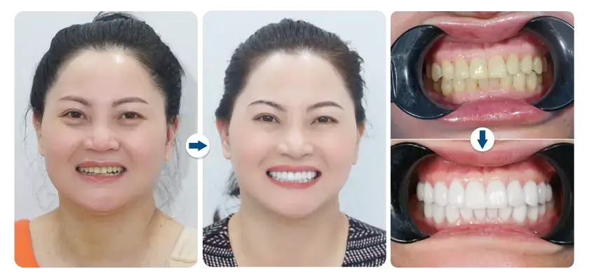 kieu-loan-dan-su-veneer-lisi