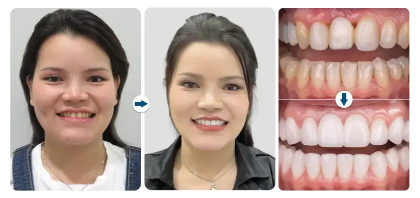 samatha-nguyen-dan-su-veneer-emax