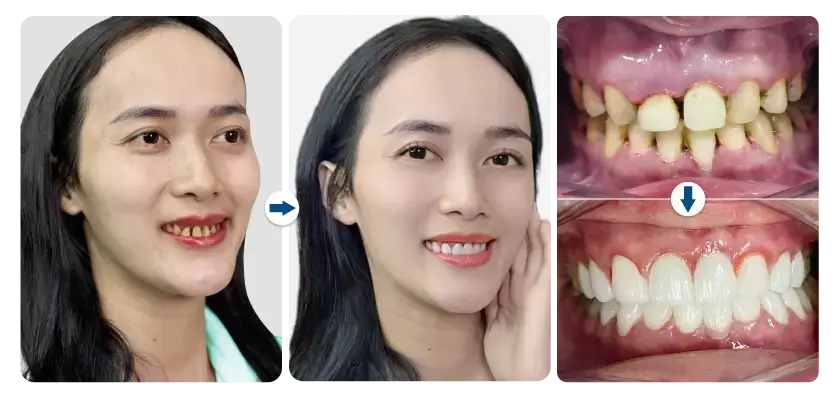 bao-an-boc-su-zirconia