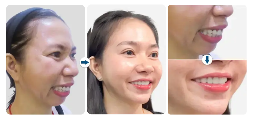 kieu-trinh-phau-thuat-ham-ho