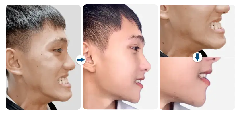 minh-duc-phau-thuat-ham-mom