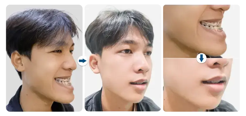 thanh-nguyen-phau-thuat-ham-mom