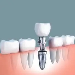 rang-tam-co-dinh-tren-implant