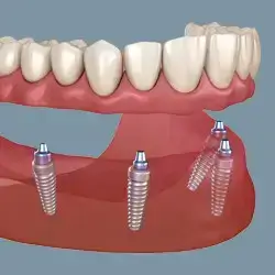 implant-toan-ham-all-on-4