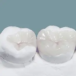 inlay-onlay-zirconia