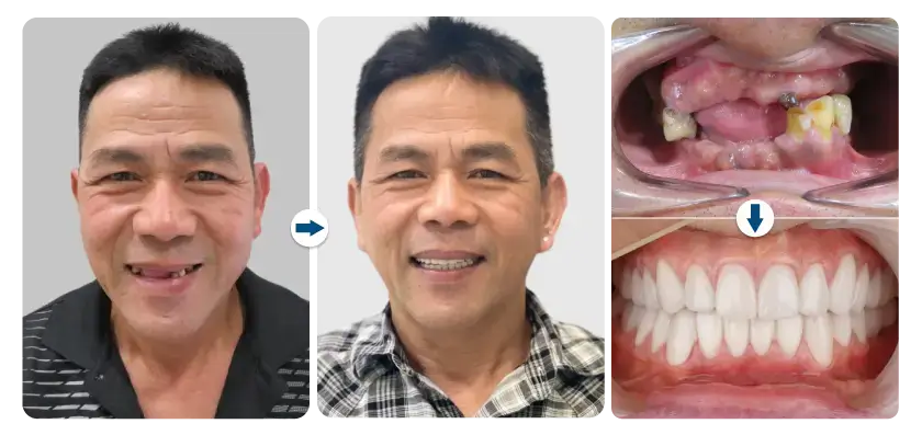 tony-tran-cay-ghep-implant-toan-ham