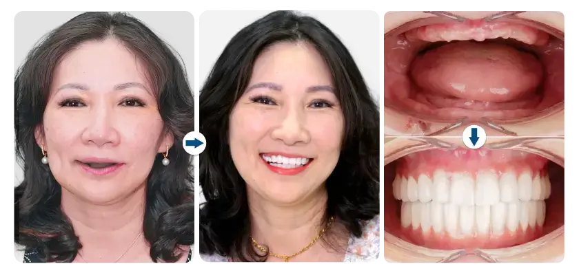 nhat-phuong-cay-ghep-2-tru-implant-toan-ham
