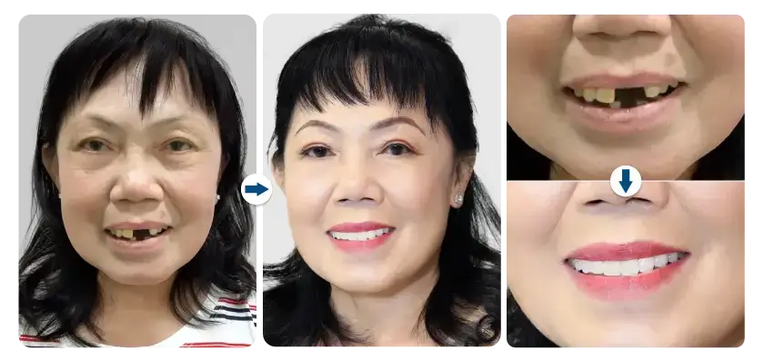 quynh-hoa-cay-ghep-2-tru-implant