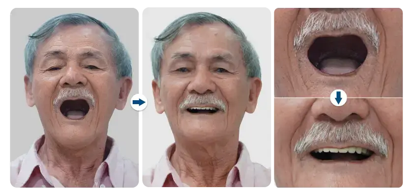 cong-uan-cay-ghep-implant-toan-ham