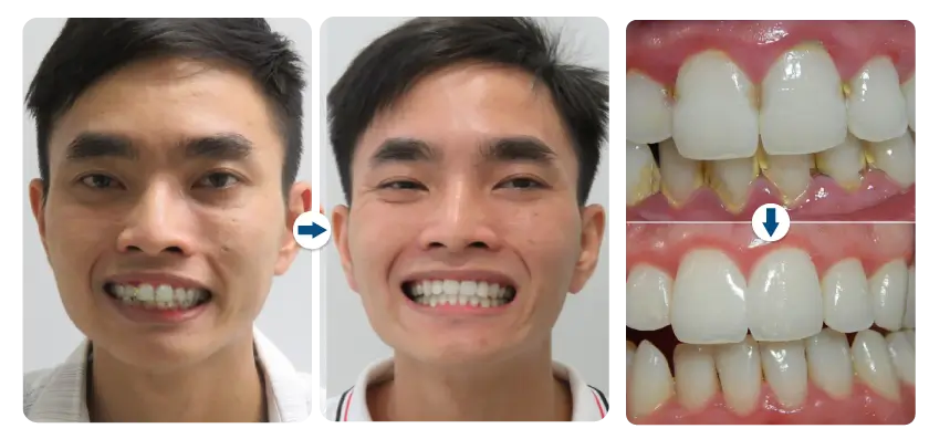 huu-tri-cao-voi-rang