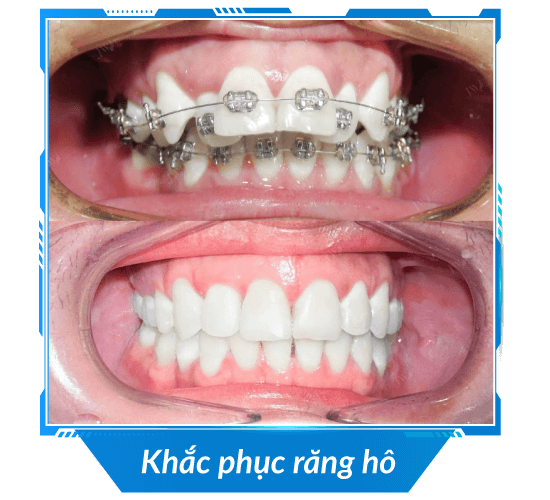 khac-phuc-ham-ho