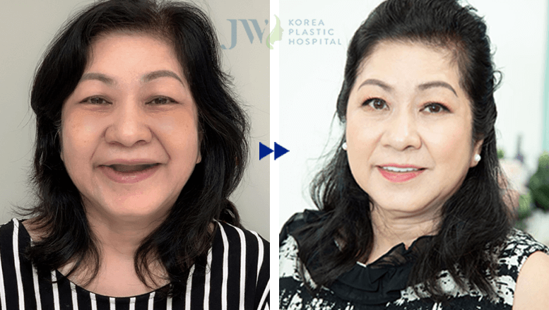 Hè sang Răng trắng sáng