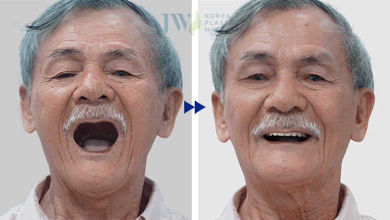 Hè sang Răng trắng sáng