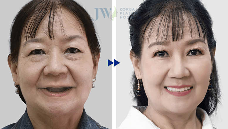 Hè sang Răng trắng sáng