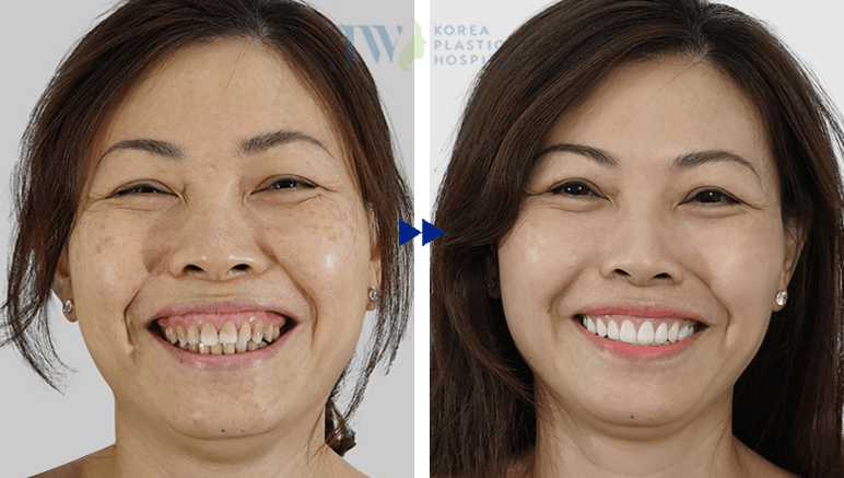 Hè sang Răng trắng sáng