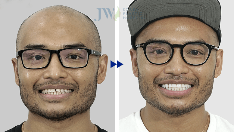 Hè sang Răng trắng sáng