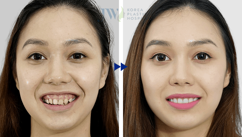 Hè sang Răng trắng sáng