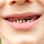 Dấu hiệu của bệnh sâu răng ai cũng phải biết – Nha Khoa JW