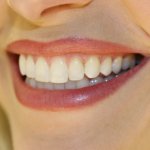 Trồng răng sứ an toàn – nét đẹp thẩm mỹ mang vẻ đẹp tự nhiên