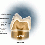 Bọc răng sứ Lava 3M là gì