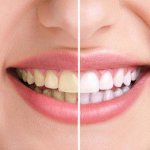 Những cách phòng ngừa bị bệnh cao răng bạn nên biết