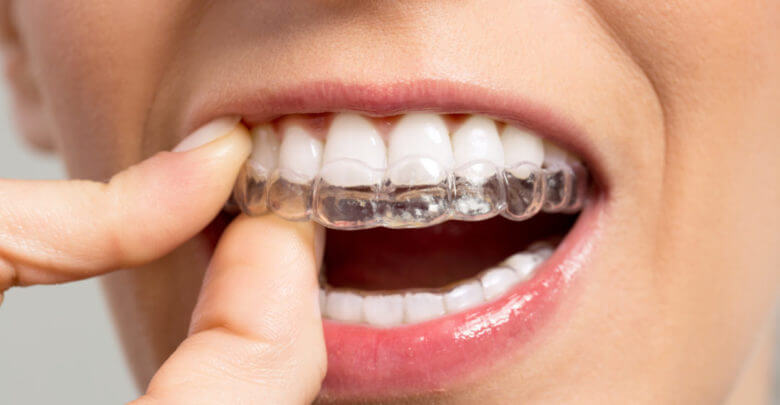 Niềng răng vô hình - Đỉnh cao chỉnh nha trong niềng răng thẩm mỹ | Nha Khoa  Hàn Quốc