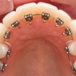 Những điều cần biết về niềng răng mặt trong – Nha Khoa JW