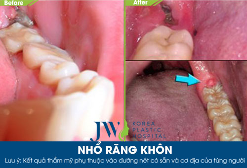 nho-rang-khon