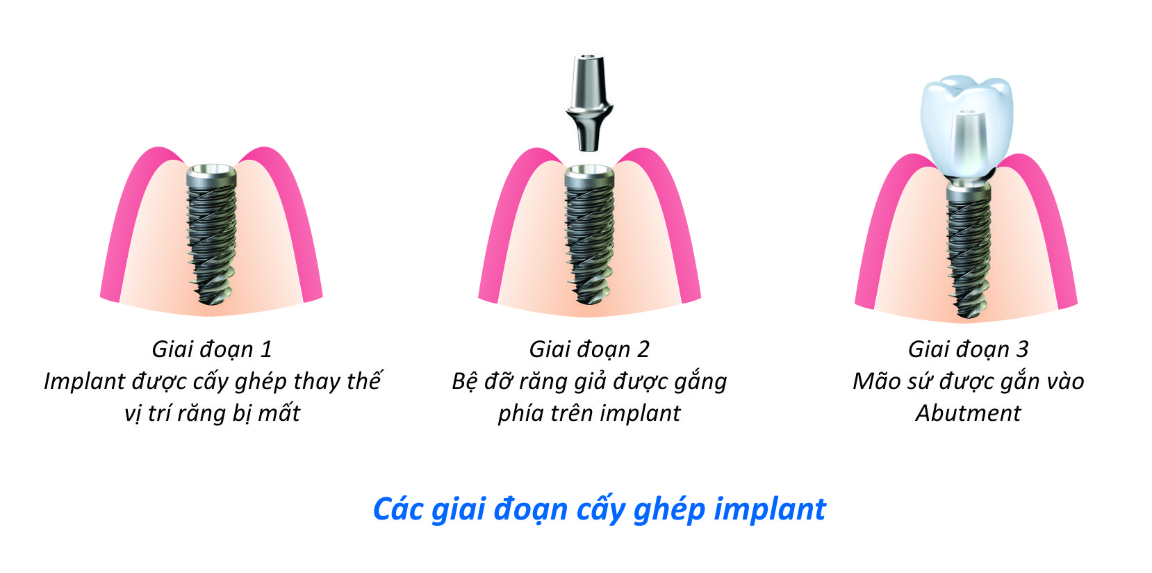 cay-ghep-implant-gia-bao-nhieu