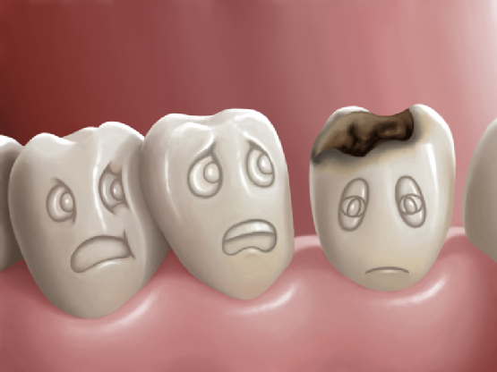 Sâu răng và cách điều trị