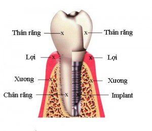 nhung-loi-ich-tuyet-voi-ma-ban-nen-biet-khi-cay-ghep-rang-implant