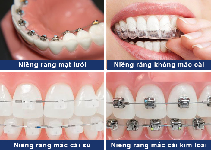 Niềng răng được phát triển với nhiều loại hình 