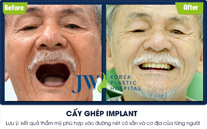 khách hàng cấy ghép implant