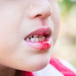 Những điều cần lưu ý khi bé mọc răng bị chảy máu
