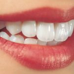 Cấy ghép răng Implant mất bao nhiêu tiền cho hàm răng chắc khỏe