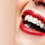 Gắn kim cương lên răng có an toàn không – Hãy thận trọng