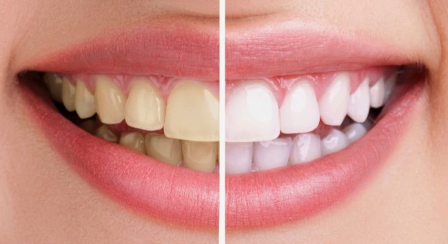 Tẩy trắng răng có tác dụng phụ không?