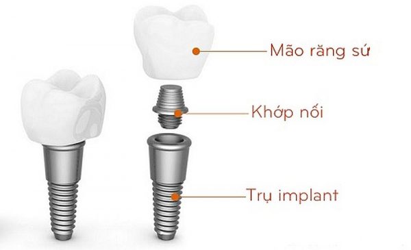 Cấy ghép Implant là gì?