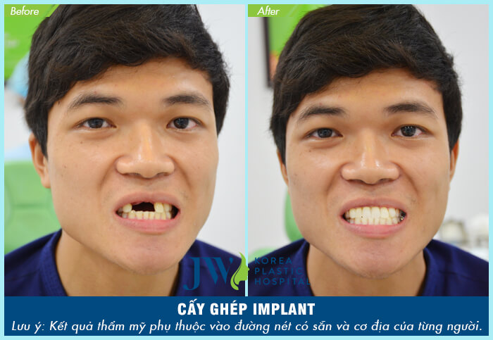 Hình ảnh khách hàng thực hiện cấy ghép implant tại JW