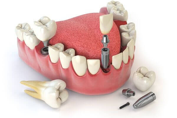 Các chuyên gia nha khoa khuyên bạn nên cấy ghép implant thay vì thực hiện cầu răng sứ