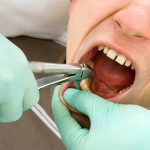 Nhổ răng có ảnh hưởng đến thần kinh không?