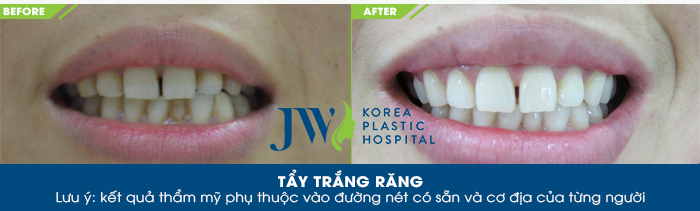 Khách hàng tẩy trắng răng tại JW 