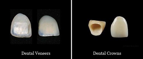 công nghệ răng sứ nano