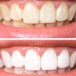 Có giải pháp làm trắng răng nào an toàn hiệu quả không?