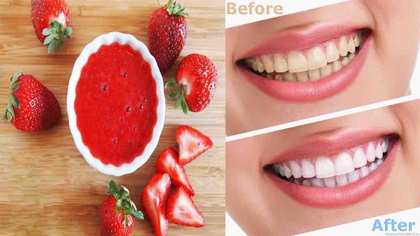 Dùng phương pháp tẩy trắng răng tự nhiên thì việc làm cho răng xỉn màu cũng sẽ song song với việc tẩy trắng