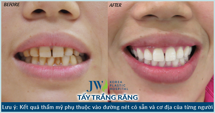 Khách hàng sỡ hữu hàm răng trắng đẹp sau khi tẩy trắng răng tại JW